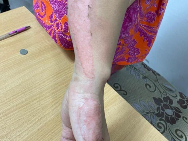 Бишкекте эркек киши жарандык никеде жашаган аялын үтүк менен күйгүзүп кыйнаган