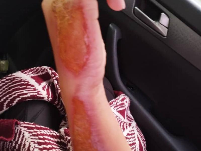 Бишкекте эркек киши жарандык никеде жашаган аялын үтүк менен күйгүзүп кыйнаган