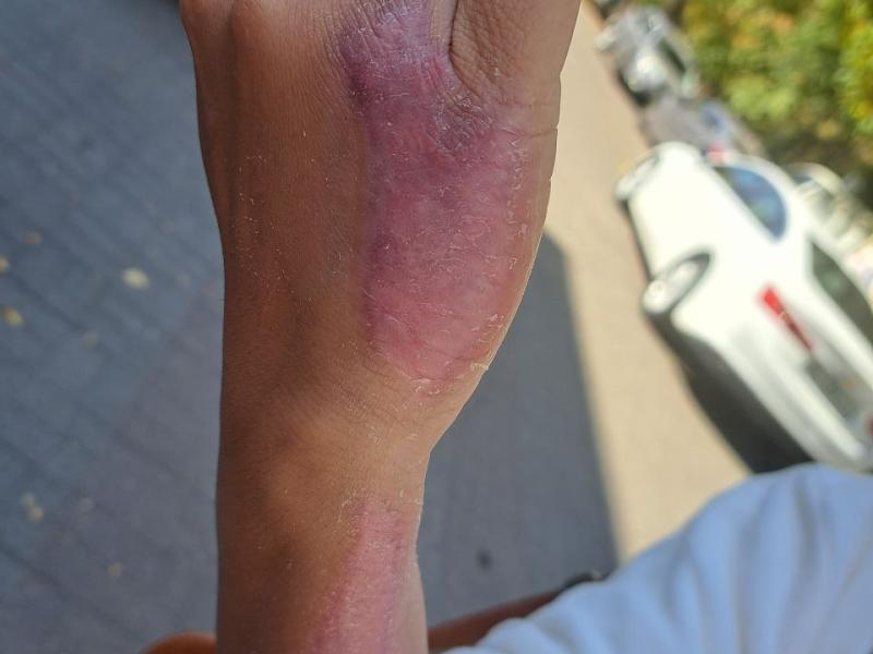 In Bishkek, a man tortured his common-law wife by burning her with an iron